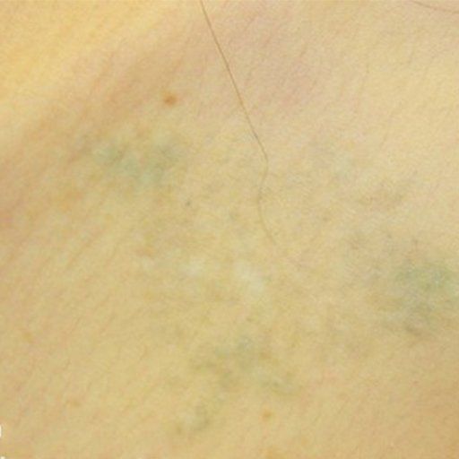 A close up of a person 's skin with a green spot on it.