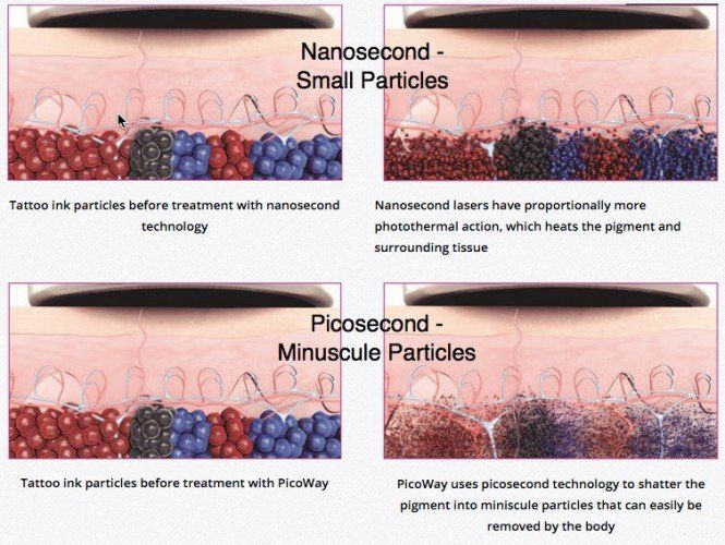 nano_vs_pico_tattoo_removal