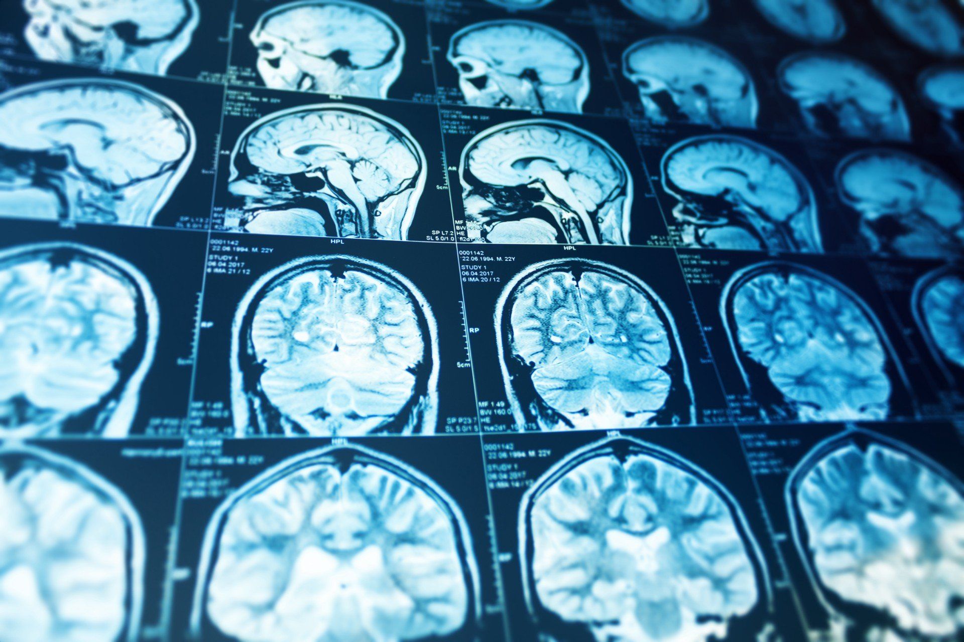 Brain x-ray report
