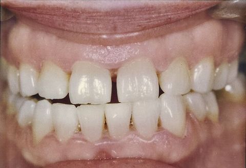 after teeth whitening