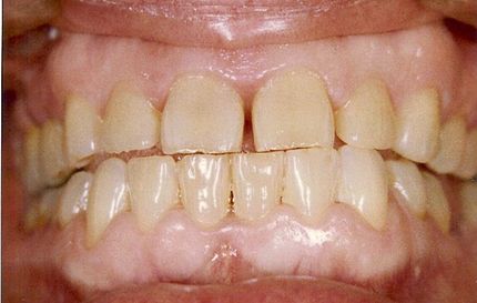 before teeth whitening