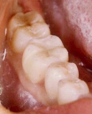 white filling