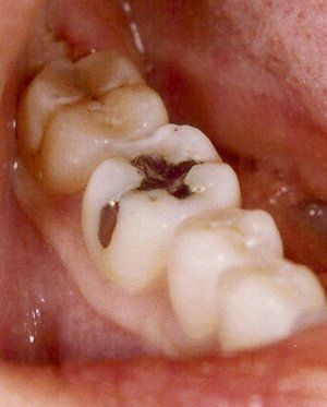 composite filling