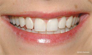 Porcelain Veneers1