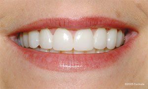 Porcelain Veneers 2