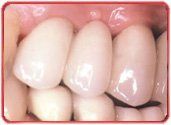 dental implants 2