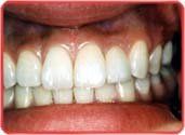 dental implants 4