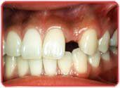 dental implants 3