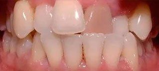 A close up of a person 's teeth with a missing tooth.