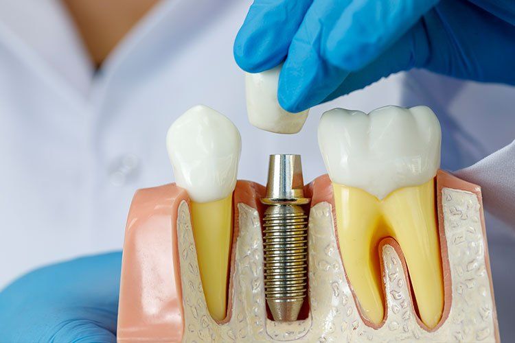 teeth sculpture and dental implant sculpture