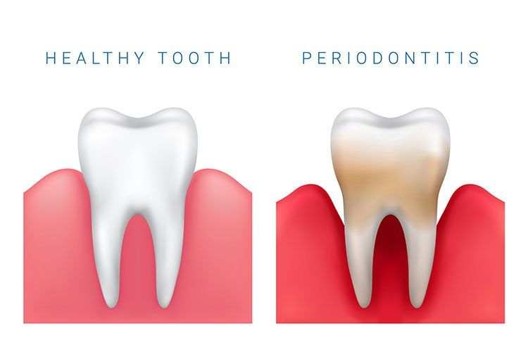 A healthy tooth and a tooth with periodontitis.