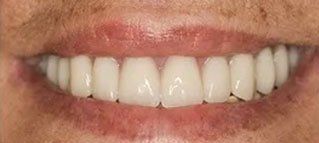 A close up of a person 's smile with white teeth.