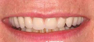 A close up of a woman 's smile with white teeth.