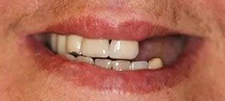 A close up of a person 's mouth with a missing tooth.
