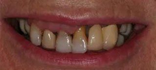 A close up of a person 's teeth with a missing tooth.