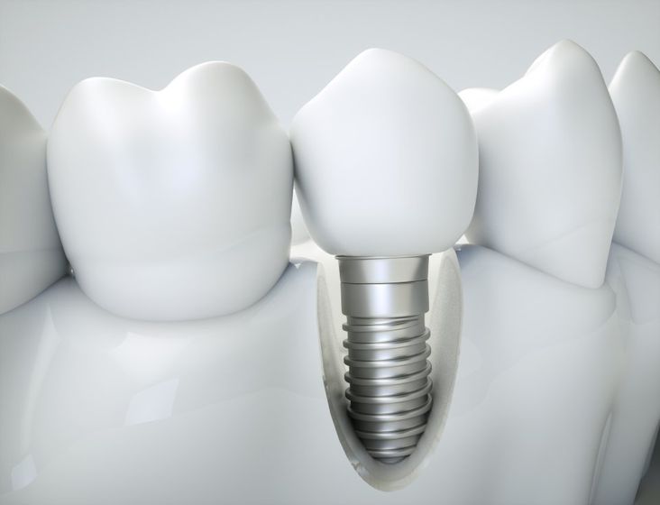 illustrazione di un dente impiantato