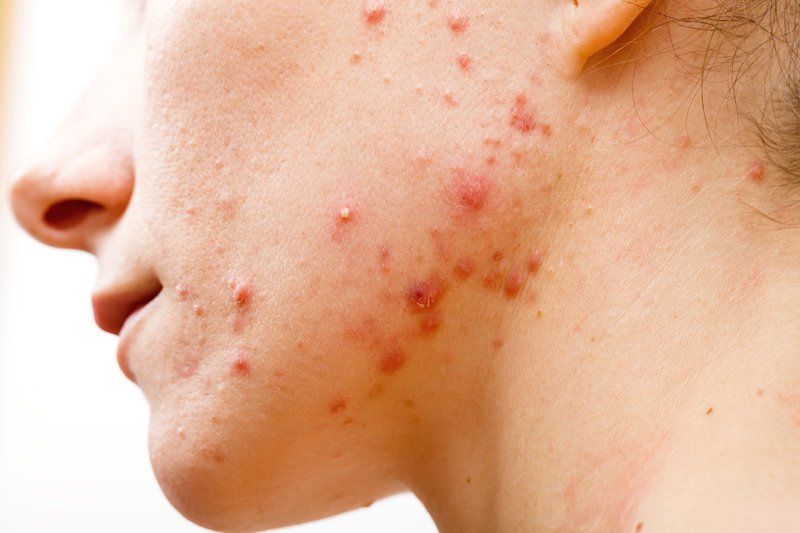 pelle con acne