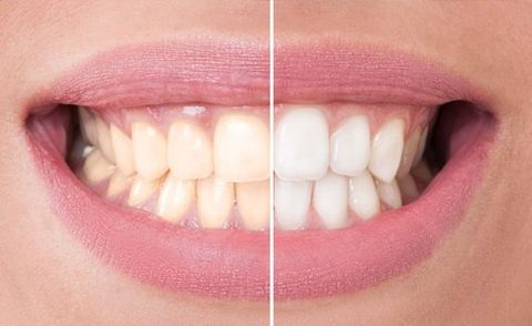 before and after teeth bleaching