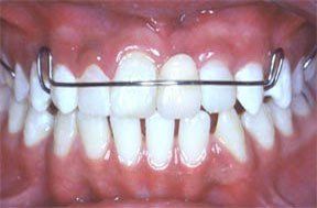 Dentures Gallery 4