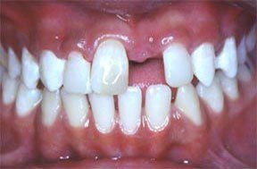 Dentures Gallery 3