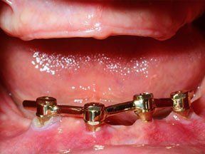 Implant Gallery 6