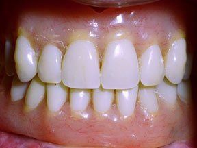 Implant Gallery 9
