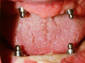 Implant Gallery 8