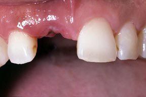 Implant Gallery 1