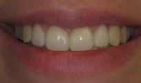 Veneers Gallery 2