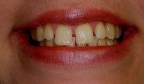 Veneers Gallery 1