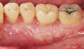Periodontal Gallery 2