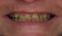 Veneers Gallery 3