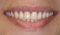Dentures Gallery 2