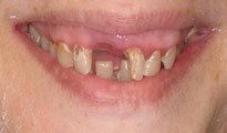 Dentures Gallery 1