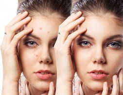 Woman With Problem Skin On Her Face Before And After — Dermatology in Howard Beach, NY Woman With Problem Skin On Her Face Before And After — Dermatology in Howard Beach, NY