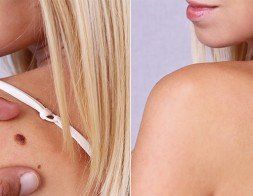 Later Treatment Before And After — Dermatology in Howard Beach, NY Later Treatment Before And After — Dermatology in Howard Beach, NY