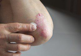 Psoriasis On Elbow — Dermatology in Howard Beach NY Psoriasis On Elbow — Dermatology in Howard Beach NY
