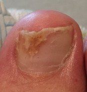 fungal feet