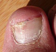 unhealthy nail