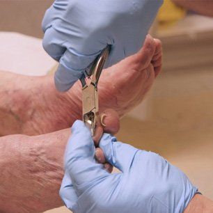 fungal nail treatment