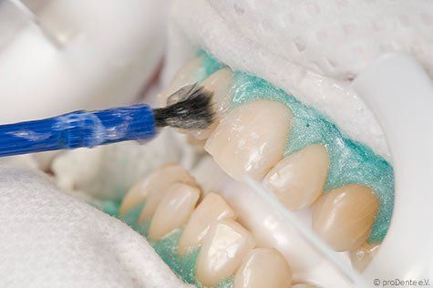 Auftragen des Bleaching-Gels