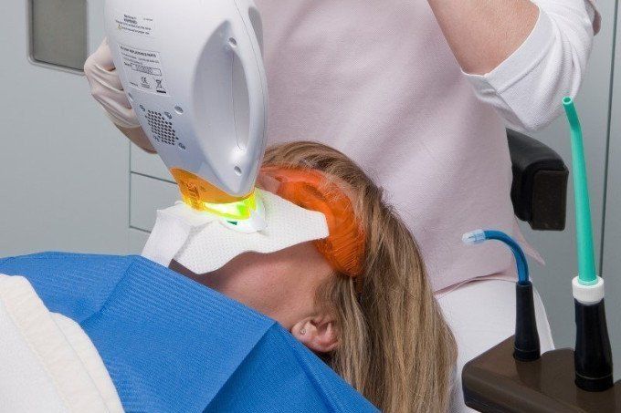 Belichtung des Bleaching-Gels