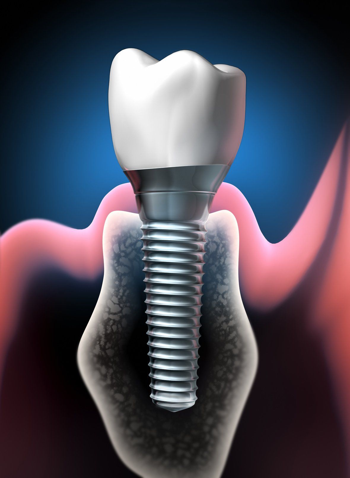 Implantat: Schraubenförmige Wurzel im Kiefer (unten) mit aufgesetzter Krone (oben) Implantat: Schraubenförmige Wurzel im Kiefer (unten) mit aufgesetzter Krone (oben) (© psdesign1 - Fotolia.com)