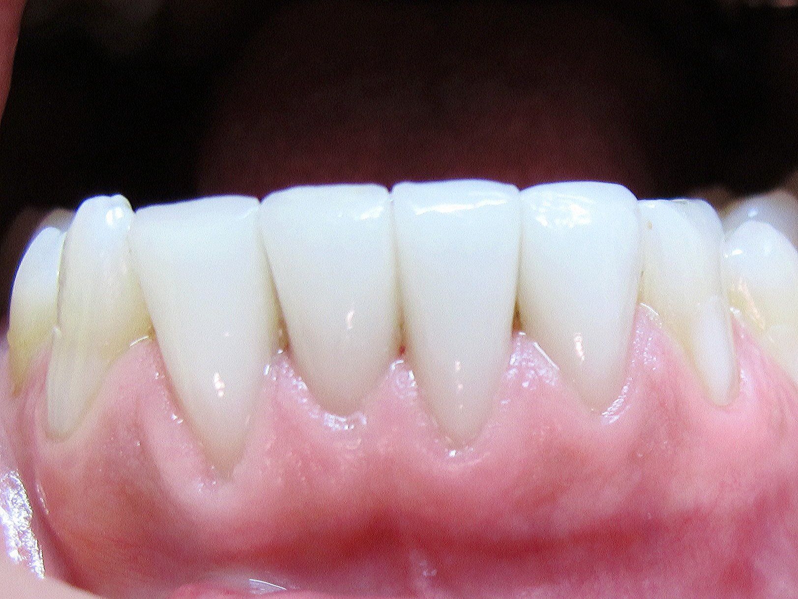 Veneers der unteren vier Schneidezähne Veneers der unteren vier Schneidezähne