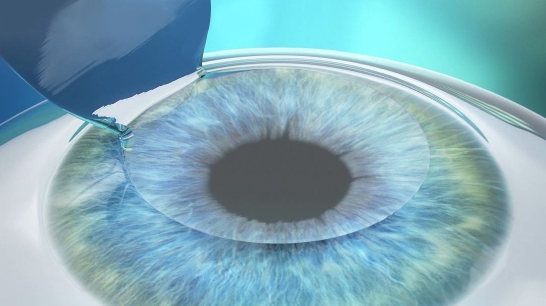 interventi oculistici