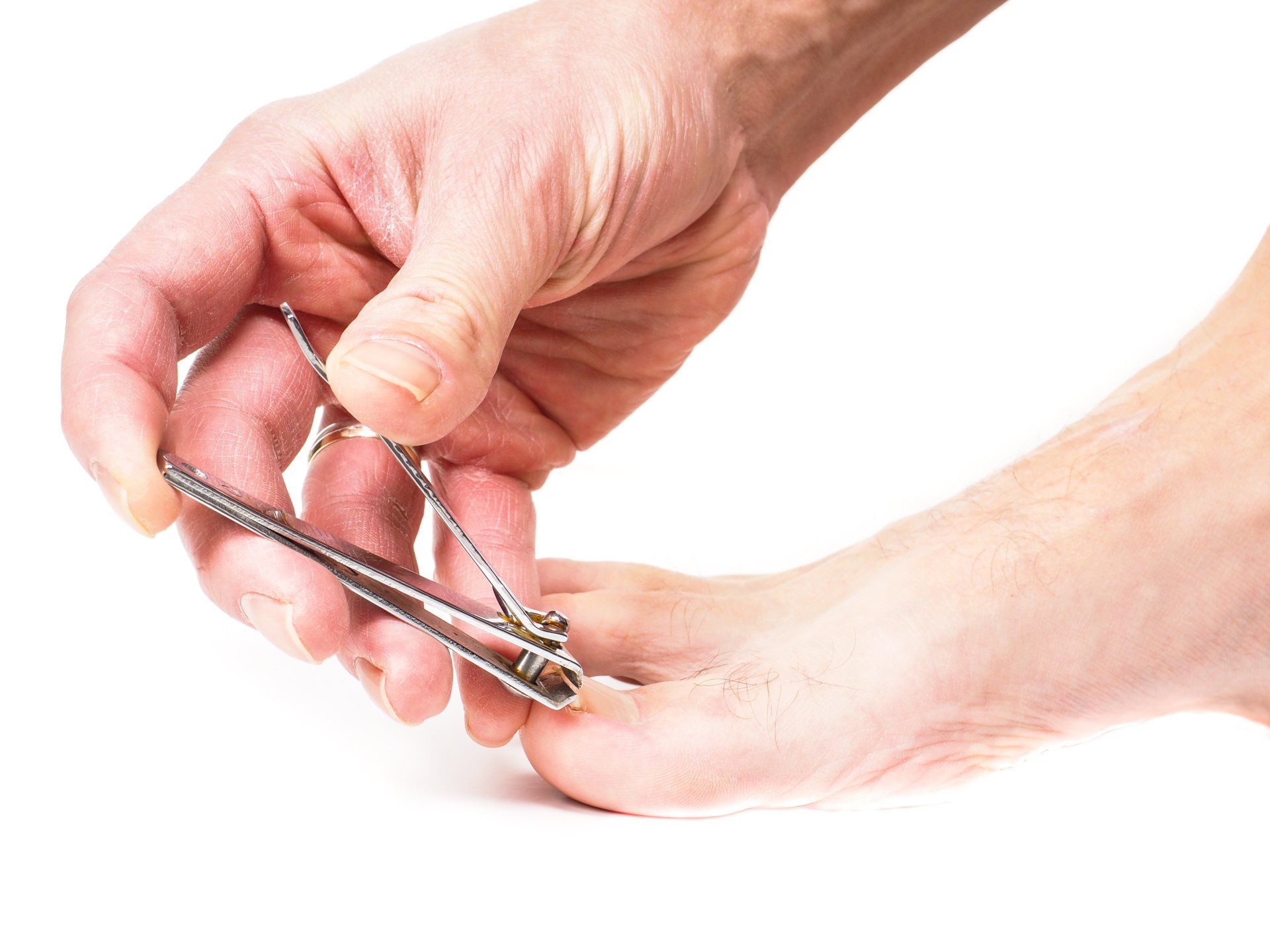 Ingrown Toenail Removal Delray Beach