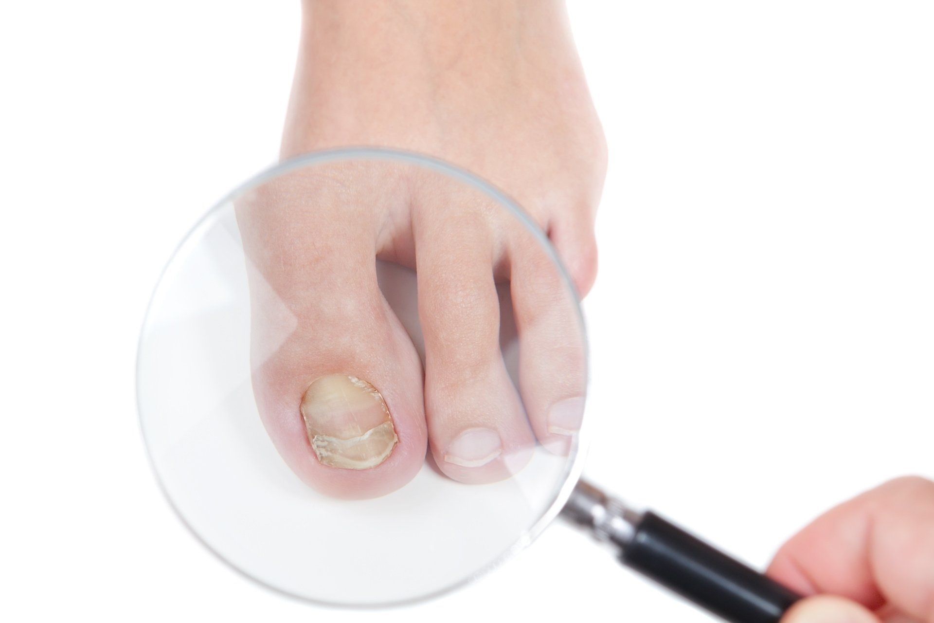 Toenail Fungus Treatment Delray Beach