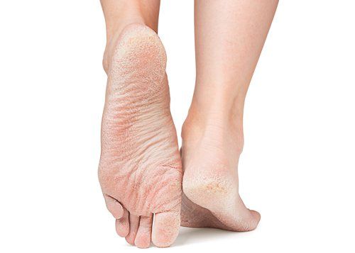 Skin Conditions — Dry Feet in Lake Zurich, IL Skin Conditions — Dry Feet in Lake Zurich, IL