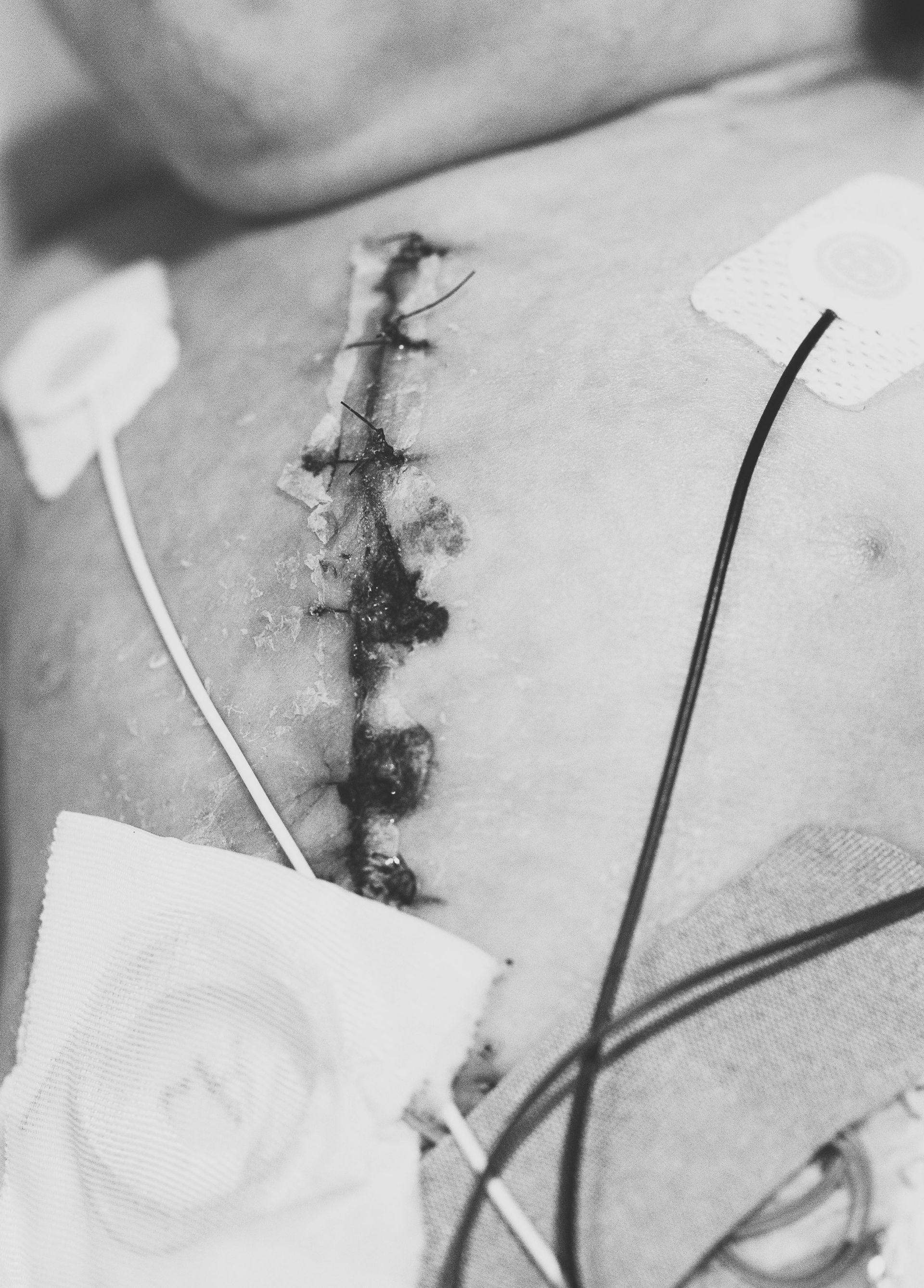 world of broken hearts congenital heart disease treatment