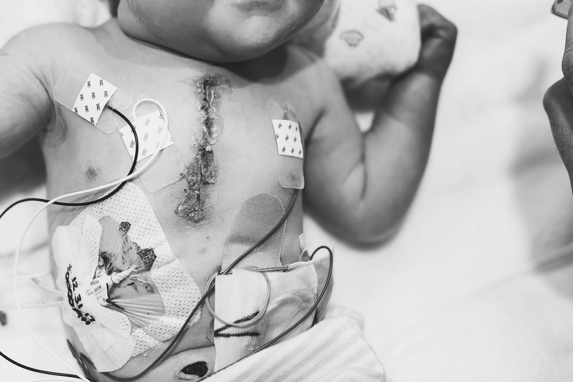 baby in the hospital with CHD world of broken hearts